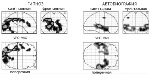 Рисунок 1. Зоны мозга, в которых наблюдалось увеличение регионарного кровотока (regional cerebral blood flow, rCBF) во время гипноза по сравнению с кровотоком во время реконструирования автобиографических воспоминаний (слева), и зоны мозга, в которых наблюдалось увеличение rCBF во время реконструирования автобиографических воспоминанию по сравнению с состоянием покоя (справа). Результаты показаны с p<0,001. (Адаптировано, Faymonville et al.,2006).
